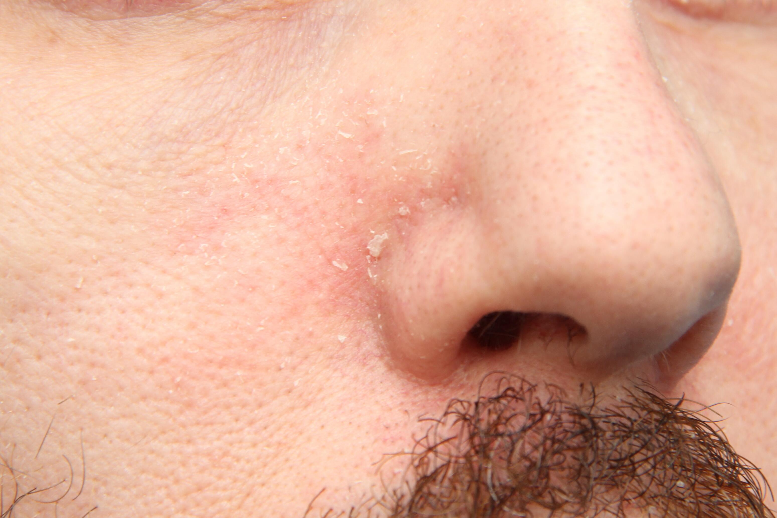 Seborroïsche dermatis op het gezicht